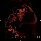 AVM_2_intranidal_aneurysms
